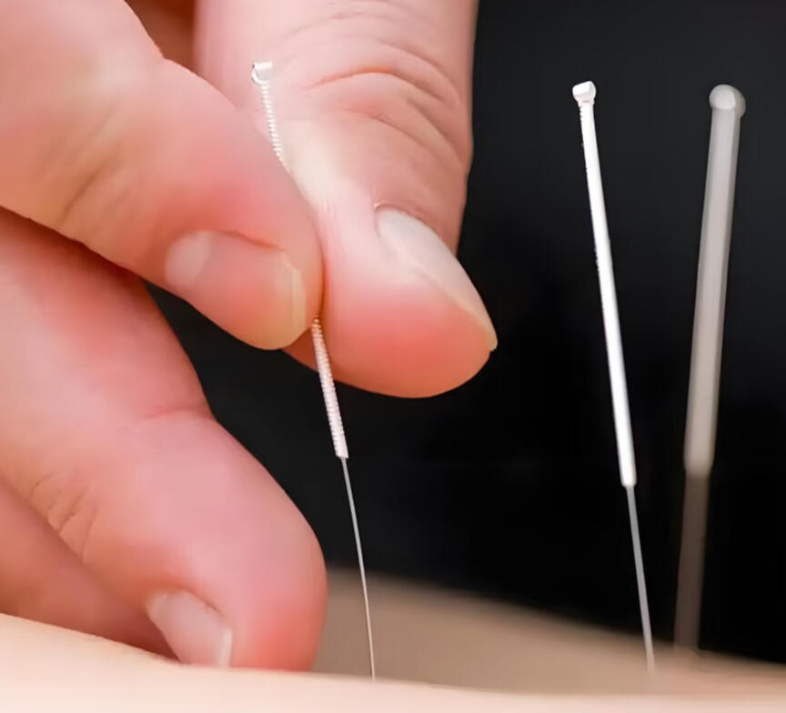 Acupuncture treatment close-up